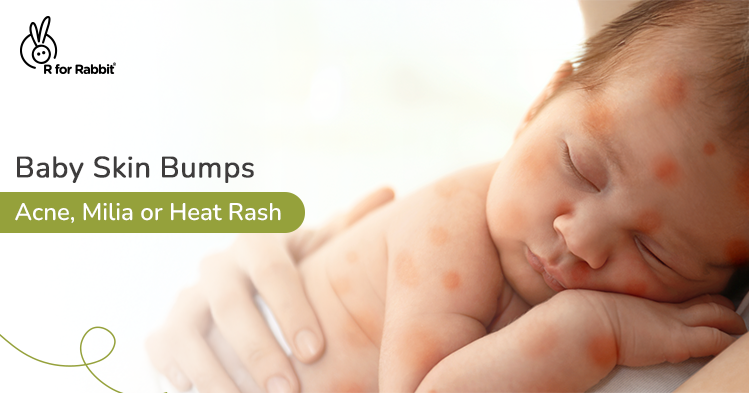 Baby Acne vs Milia vs Heat Rash: How to Tell the Difference
